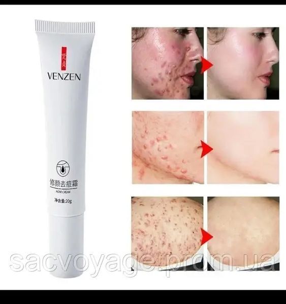 Крем від прищів та акне на рослинній основі Venzen acne crem 20 мл 030401 фото